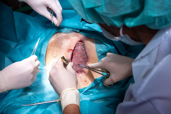 Patiënt Een Gespleten Huid Buik Heeft Getransplanteerd Een Wond Bedekken — Stockfoto