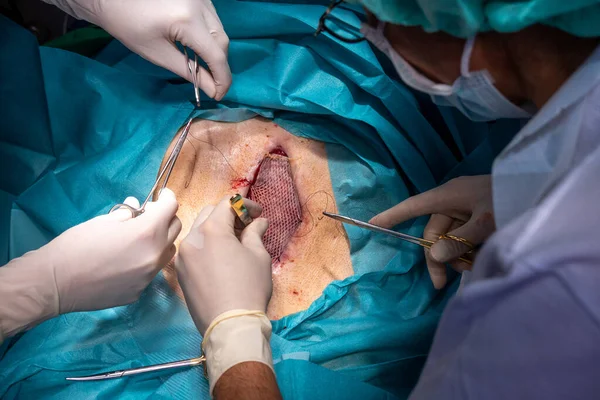 Paciente Tem Pele Dividida Transplantada Abdômen Para Cobrir Uma Ferida — Fotografia de Stock