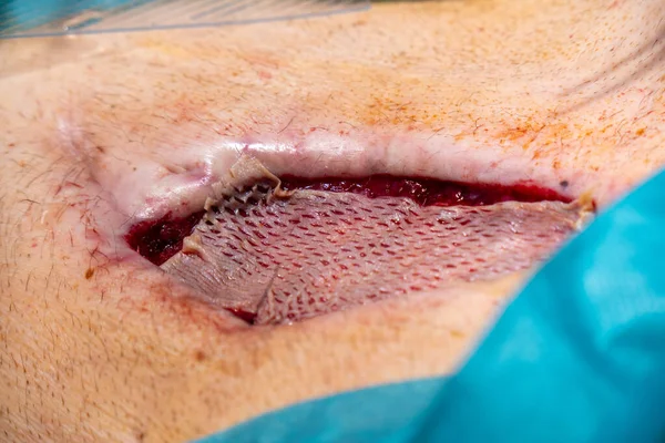 patient has split skin transplanted on the abdomen to cover a wound