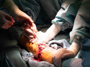 Bir ameliyathanede alt bacak ampütasyonu uygulanır.