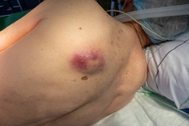 Bir hastanın sırtında büyük bir apse oluşur.