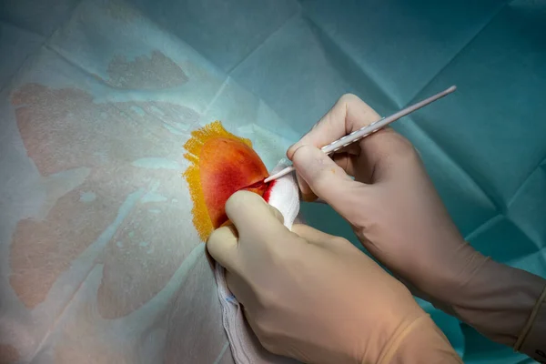 Operationssaal Wird Der Abszess Eines Patienten Von Einem Arzt Operiert — Stockfoto