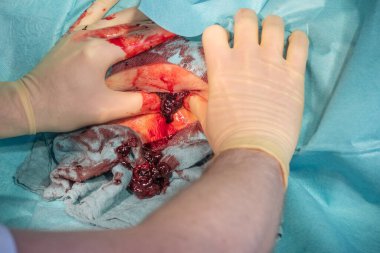 Ameliyathanede bir hastanın hematomu bir doktor tarafından ameliyat edilir.