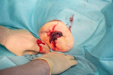 Ameliyathanede bir hastanın hematomu bir doktor tarafından ameliyat edilir.