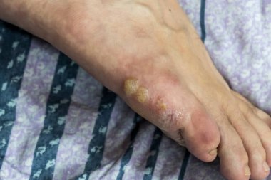 Ayakta kabarcıklar ve pul pul deri.