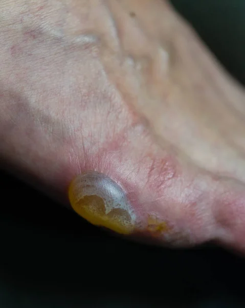 Μεγάλη Φουσκάλα Και Απολέπιση Του Δέρματος Πόδια Από Έκζεμα Pompholyx — Φωτογραφία Αρχείου