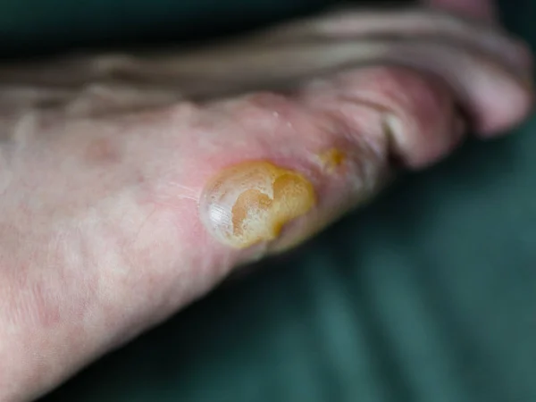 Blister Grande Pele Flocos Eczema Pompholyx — Fotografia de Stock