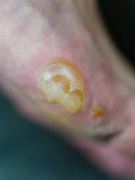 Blister Grande Pele Flocos Eczema Pompholyx — Fotografia de Stock