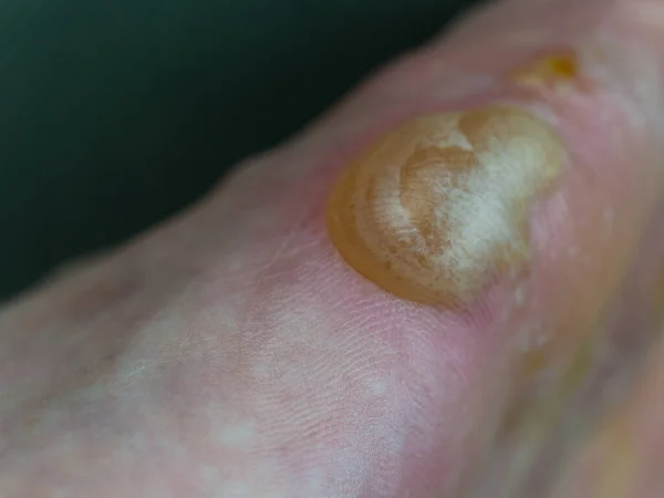 Big Blister Flaking Skin Foot Pompholyx Eczema — Stock Photo, Image