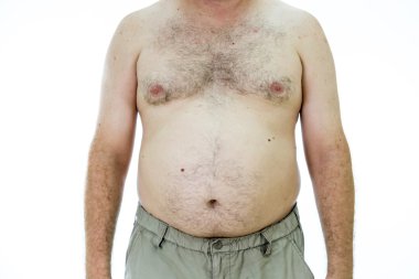 Adam şişman mide ile