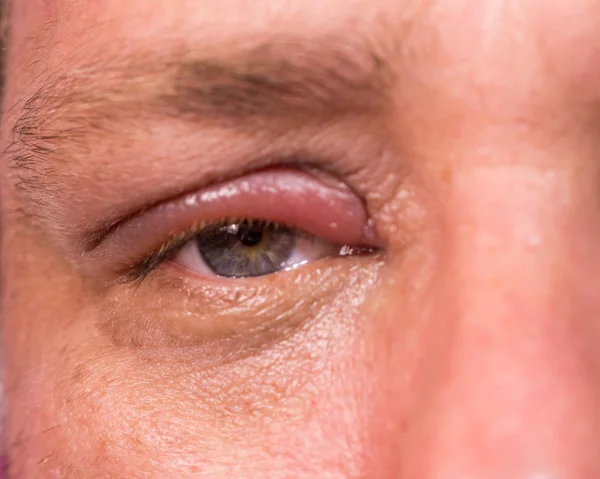 Närbild på infekterade öga — Stockfoto