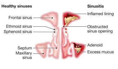 Healthy sinuses and sinusitis with inflamed lining, obstructed sinus opening, adenoid and excess mucus clipart