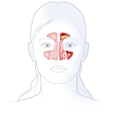 Healthy sinuses and sinusitis with inflamed lining, obstructed sinus opening, adenoid and excess mucus clipart