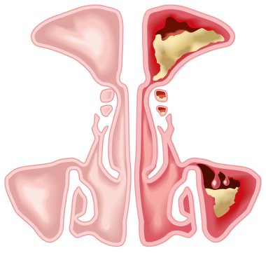 Sağlıklı sinüsler ve iltihaplı sinüs iltihabı, tıkanmış sinüs açığı, adenoid ve fazla sümük.