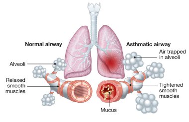Normal and asthmatic airways clipart