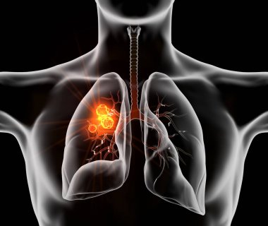Highlighted carcinoma in left lung, 3D illustration clipart