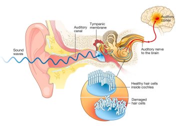 Illustration showing tinnitus. Damaged hair cells inside cochlea, labeled clipart