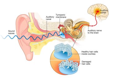 Illustration showing tinnitus. Damaged hair cells inside cochlea, labeled clipart