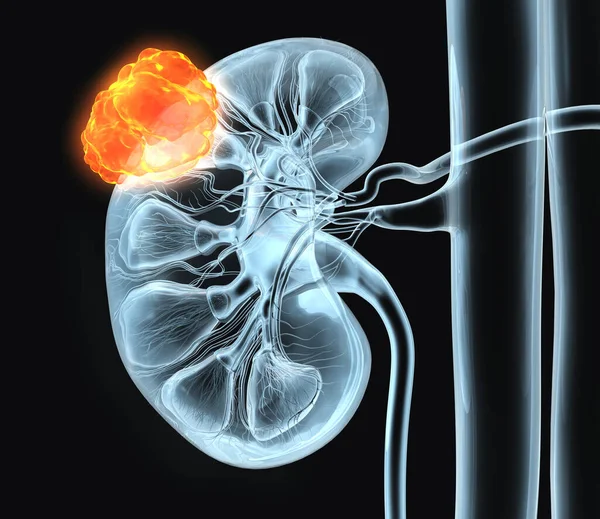Medizinische Illustration Eines Tumors Der Rechten Niere — Stockfoto
