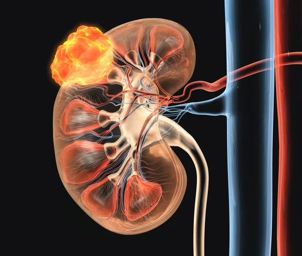 Medizinische Illustration Eines Tumors Der Rechten Niere — Stockfoto