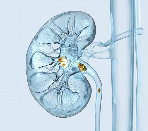 Kidney Stones Minor Major Calyces Ureter Medically Illustration — Stock Photo, Image