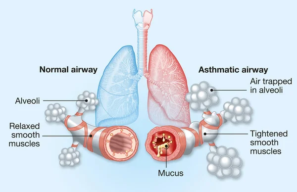 Normál Asztmás Légutak — Stock Fotó