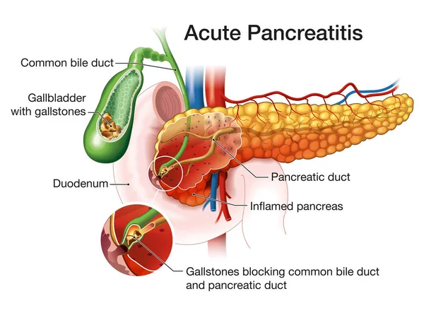 Inflamed Pancreas Gallstones Blocking Bile Duct Pancreatic Duct — Stock Photo, Image