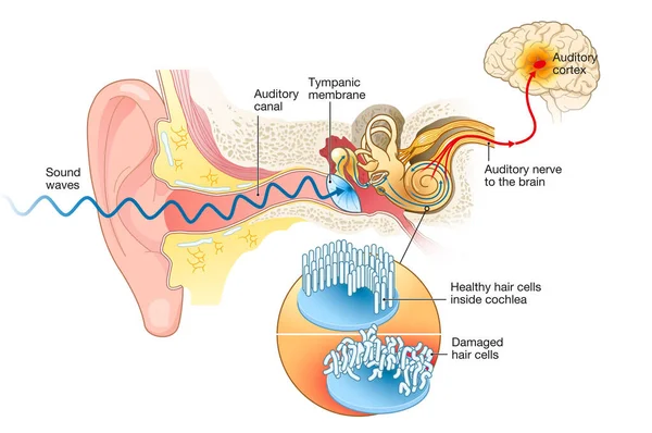 耳鳴りを示すイラスト 人工内耳の損傷を受けた毛細胞は — ストック写真