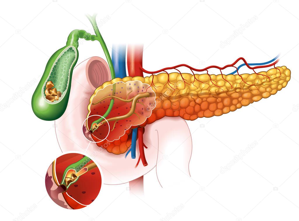 Inflamed pancreas, gallstones blocking bile duct and pancreatic duct