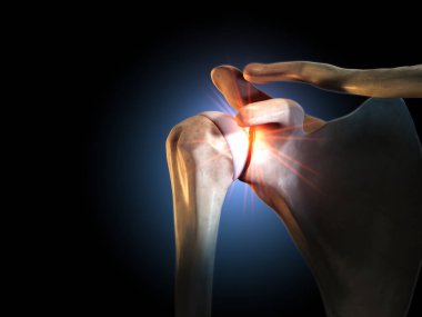 Painful shoulder joints, medical 3D illustration clipart