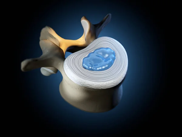 Ilustração Mostrando Vértebra Lombar Com Disco Intervertebral Núcleo Pulposo Herniado — Fotografia de Stock