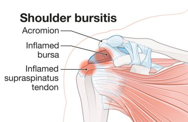 Shoulder bursitis. Inflamed bursa and supraspinatus tendon clipart