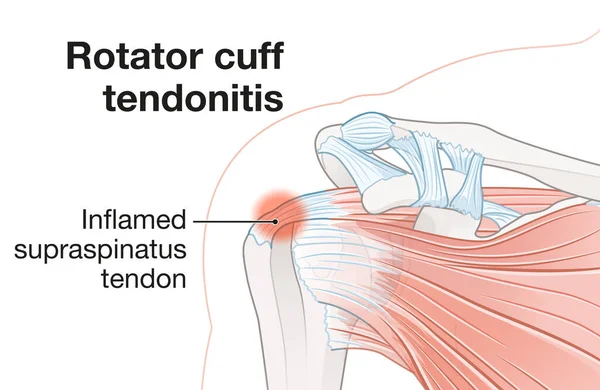 Anatomía Del Hombro Tendinitis Del Manguito Rotador Tendón Supraspinatus Inflamado — Foto de Stock