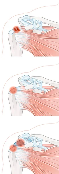 Rodzaje Bólu Barku — Zdjęcie stockowe