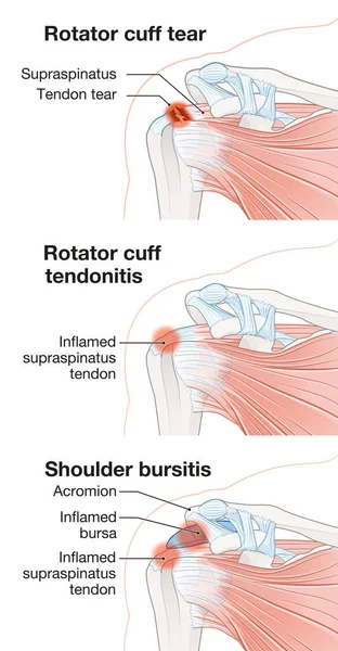 Shoulder Pain Rotator Cuff Tear Rotator Cuff Tendonitis Shoulder Bursitis — Stock Photo, Image