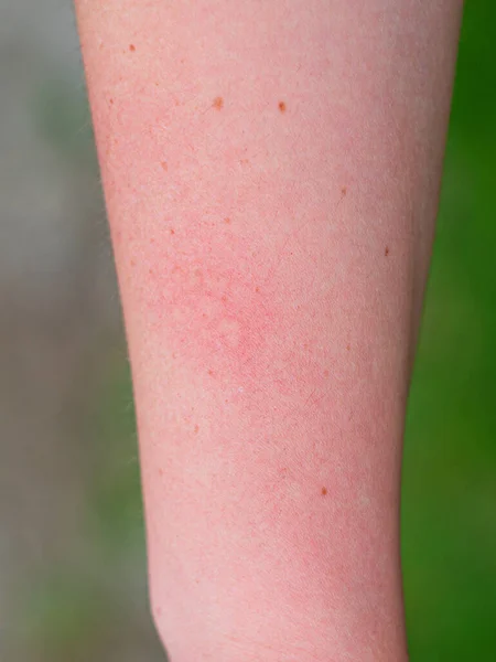 Mão Com Dermatite Pele Inchada Prurido Vermelho Depois Tocar Folhas — Fotografia de Stock