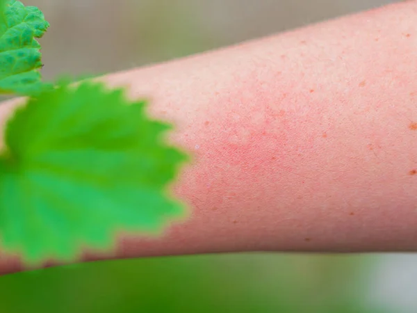 Hand Dermatitis Red Itchy Swollen Skin Touching Nettle Leaves Sharp — Stock Photo, Image