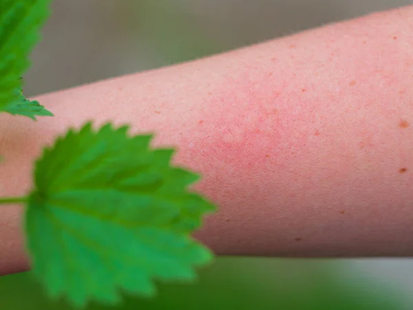 Hand Dermatitis Red Itchy Swollen Skin Touching Nettle Leaves Sharp — Stock Photo, Image