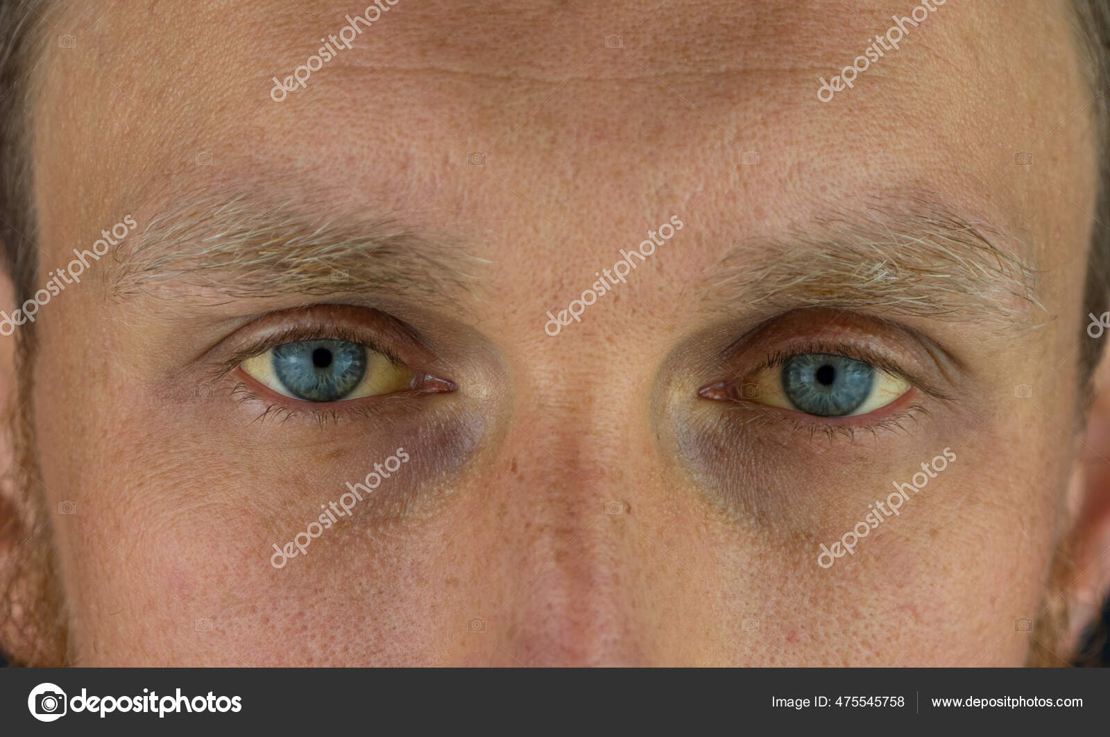 Mens Eyes Obstructive Jaundice Yellowish Real People Liver Dysfunction