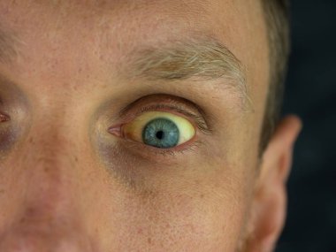 Mens eyes obstructive Jaundice yellowish. Real people liver dysfunction icteruswith cirrhosis hepatitis symptom face skin. Young man bilirubin pigmentation biliary tract obstruction Gilbert's syndrome