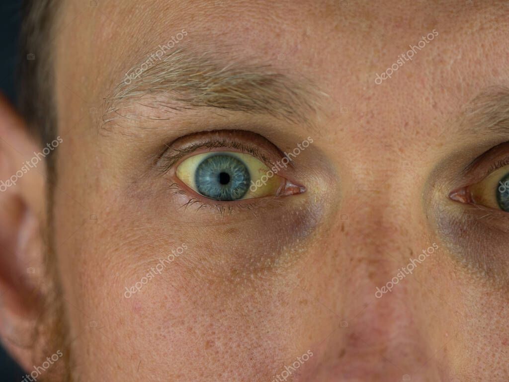 Mens eyes obstructive Jaundice yellowish. Real people liver dysfunction