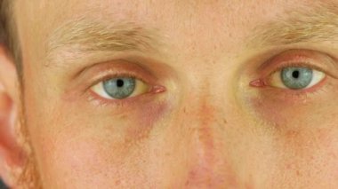 Mens eyes obstructive Jaundice yellowish. Real people liver dysfunction icteruswith cirrhosis hepatitis symptom face skin. Young man bilirubin pigmentation biliary tract obstruction Gilbert's syndrome