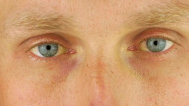Mens eyes obstructive Jaundice yellowish. Real people liver dysfunction icteruswith cirrhosis hepatitis symptom face skin. Young man bilirubin pigmentation biliary tract obstruction Gilbert's syndrome