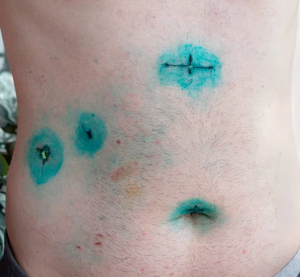 Męskie Ciało Nacięciami Operacji Laparoskopowej Pęcherzyka Żółciowego Usunięcie Endoskopii Kamieni — Zdjęcie stockowe