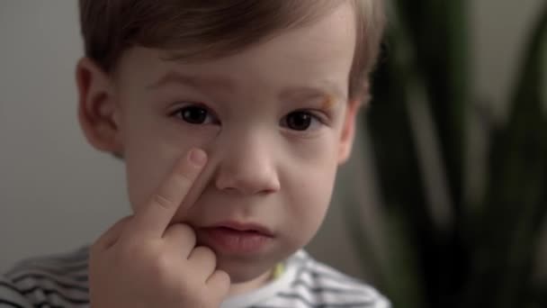 Zbliżyć się mały chłopiec w przedszkolu patrzy w kamerę i wskazuje palcem na jodynę rozmazany trądzik na twarzy. portret dziecka z leczonymi brodawkami lub mięczakami w pobliżu oczu. medycyna i zdrowie, koncepcja pediatrii — Wideo stockowe