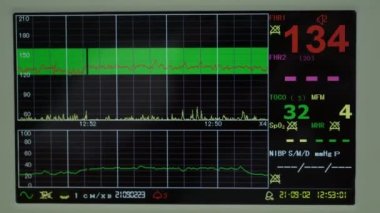 Elektronik Kardiyografi Makinesi rahmin fetal kalp kasılmalarını izliyor. Hamilelik sırasında doğum koğuşunda elektrokardiyogram çıktı. Tıbbi Teşhis Ekipmanı