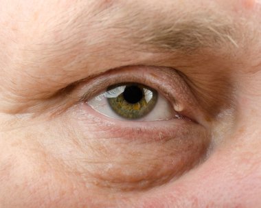 Eyelid cyst on man right upper eyelid clipart