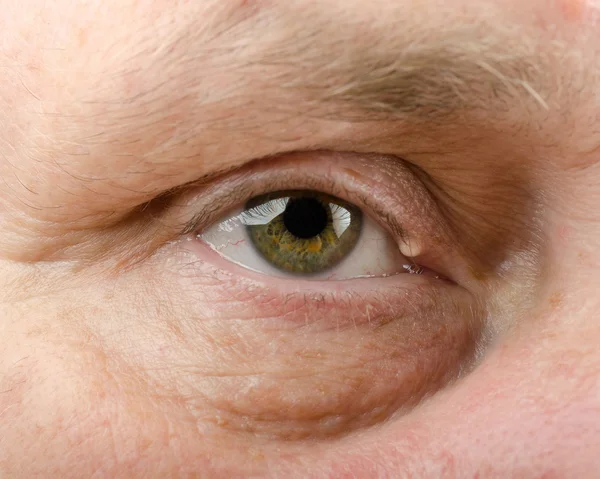 人的眼睑囊肿右眼睑 — 图库照片