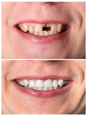 Incisive tooth restoration before and after treatment clipart