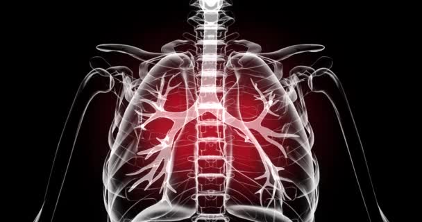 폐질환. 사람 속에 있는 폐의 염증이요. 검은 배경에 있는 사람의 엑스레이요. 결핵, 폐렴, 전염병, 코로나 바이러스의 삽화 — 비디오